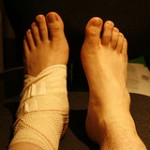 ankle injury